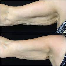 new treatment for crepy skin dr