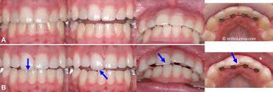 Une visite chez le dentiste permet de vérifier si la dent a bougé dans son alvéole. Traumatismes Dentaires Et Orthodontie Bucco