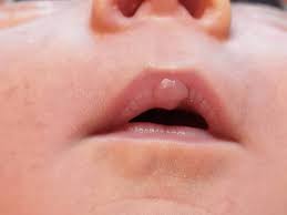 upper lip tfeeding stock photo