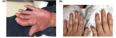 a well demarcated palmar erythema and
