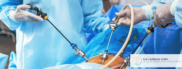 laparoscopic hiatal hernia surgery