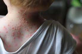 It is also called zoster or herpes zoster. Two For One Chickenpox Vaccine Lowers Shingles Risk In Children Scientific American