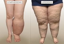lipedema surgery center is dedicated to