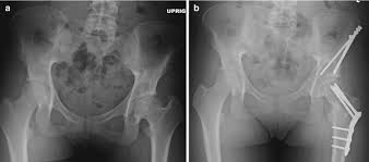 proximal fem osteotomy springerlink