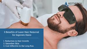 is laser hair removal a permanent