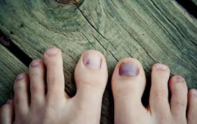 blister under your toenail here s how