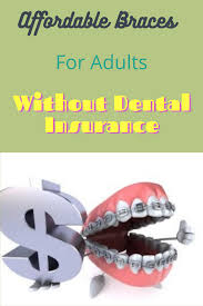 Jul 26, 2021 · when it comes to braces and orthodontics, it is important to know what your dental insurance covers and what different coverage exists for both children and adults. Affordable Braces For Adults Without Dental Insurance In 2021 Affordable Braces Dental Health Dental