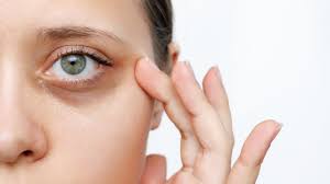 natural remes for dark eye circles