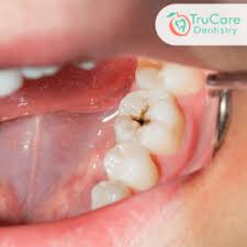 Plus, you'll know which areas of your teeth to give extra attention when cleaning. Why Do I Get Cavities Despite Brushing And Flossing My Teeth Twice A Day Trucare Dentistry Roswell