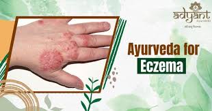 best ayurvedic treatment for eczema