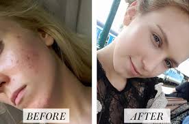 woman s before and after accutane