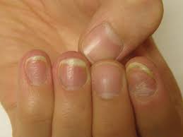 nail psoriasis tips mdedge dermatology