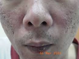 seborrhoeic dermais national skin