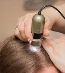 Image result for hair loss telogen effluvium treatment
