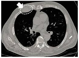 The membrane directly covering the lung tissue Jcm Free Full Text When The Diagnosis Of Mesothelioma Challenges Textbooks And Guidelines Html