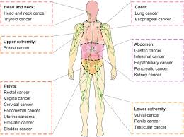 lymph node metastasis in cancer