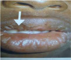 dry lips with crusting resulting from