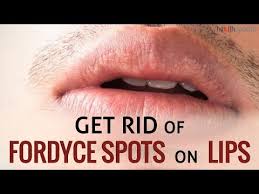 get rid of fordyce spots on lips