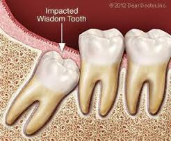 wisdom tooth extraction with dr