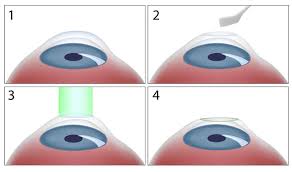 The doctor cuts a very thin flap on the eye and folds back. Florida Vision Institute Lasik Test Port St Lucie