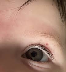 what is this on baby s eyelid mumsnet