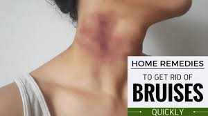 how to heal bruises naturally with home