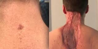 neck spot diagnosed as skin cancer man