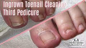 how to sore ingrown toenail salon