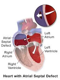 Atrial Septal Defect Wikiwand
