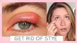 how to get rid of a stye you