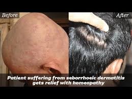 patient suffering from seborrhoeic