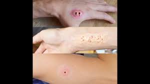 rash bites tutorial you