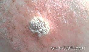 keratosis treatment how to remove