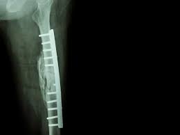 femur fracture fixation with