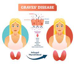graves disease eyes thyroid eye