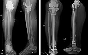 tka prosthesis by intramedullary nail