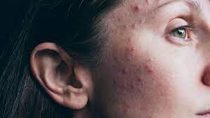 acné hormonale causes et traitements