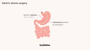 gastric sleeve surgery for weight loss