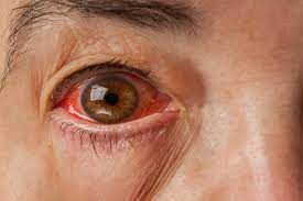 red eye common ophthalmologic