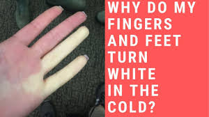 my fingers turn white in the cold