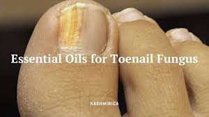 essential oils for toenail fungus