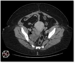 primary myxoid liposarcoma of the