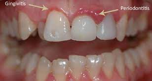 how to treat periodontal disease with