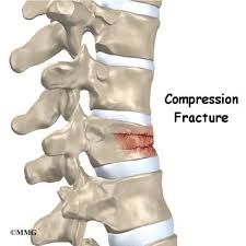 L4 and l5 fractures are commonly the result of a high impact trauma from falls or motor vehicle accidents.1 treatment for l4 and l5 fractures tend to be incident specific and differ from treatments of thoracolumbar and upper lumbar fractures.2. Patient Education Concord Orthopaedics