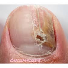 diabetes and nail infections dr