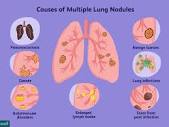 Multiple Lung Nodules: Causes, Diagnosis, and More
