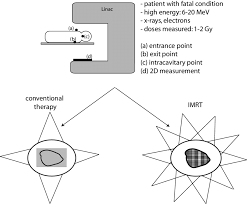 external radiation therapy