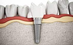 implant dentar cluj pret implante cluj