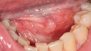 sub mucosal swelling british dental