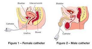 Insertion in urethra